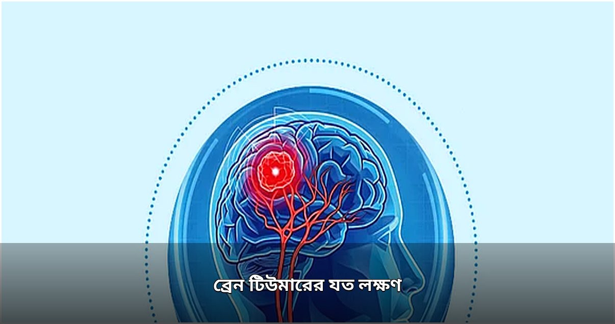 ব্রেন টিউমারের প্রধান লক্ষণগুলো কী কী
