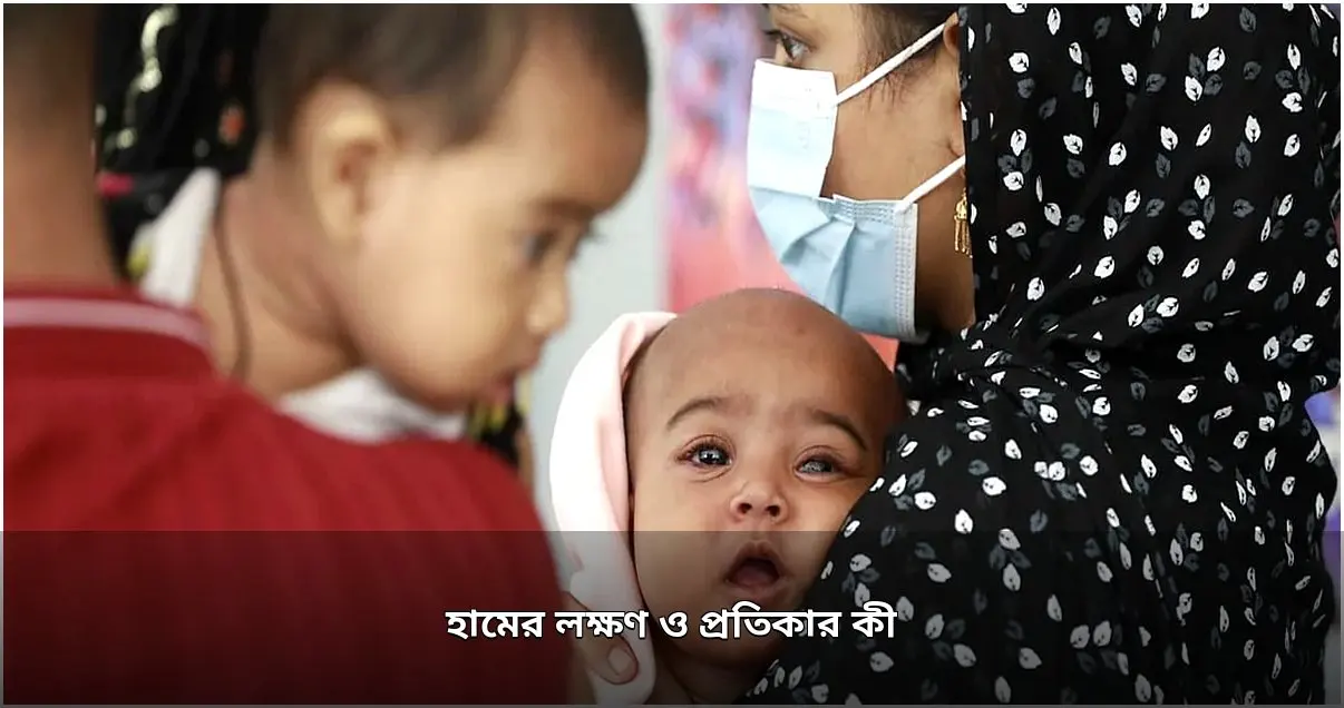 হাম: লক্ষণ, চিকিৎসা ও প্রতিরোধ