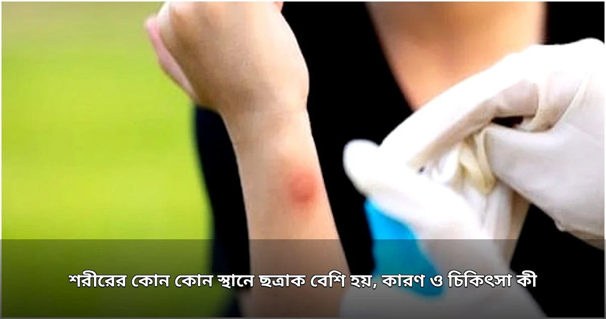 ত্বকের ছত্রাক সংক্রমণ: কারণ, লক্ষণ ও চিকিৎসা পদ্ধতি