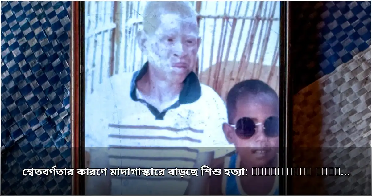 মাদাগাস্কারে শ্বেতবর্ণতার কারণে শিশু হত্যা বৃদ্ধি, ব্যাপক উদ্বেগ