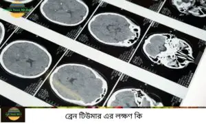 ব্রেন টিউমার এর লক্ষণ কি